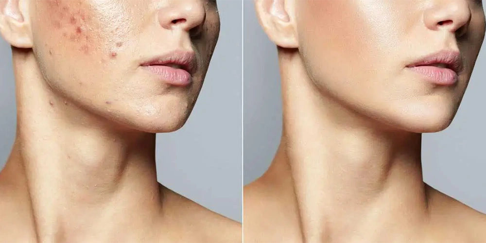 Acne Scar treatment by The Skin Clinic in Houston Texas