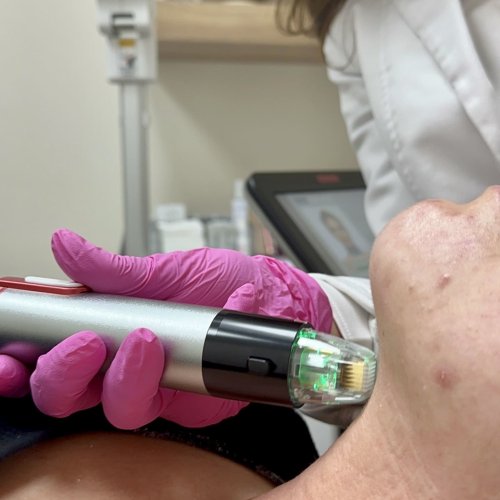 Rf Microneedling