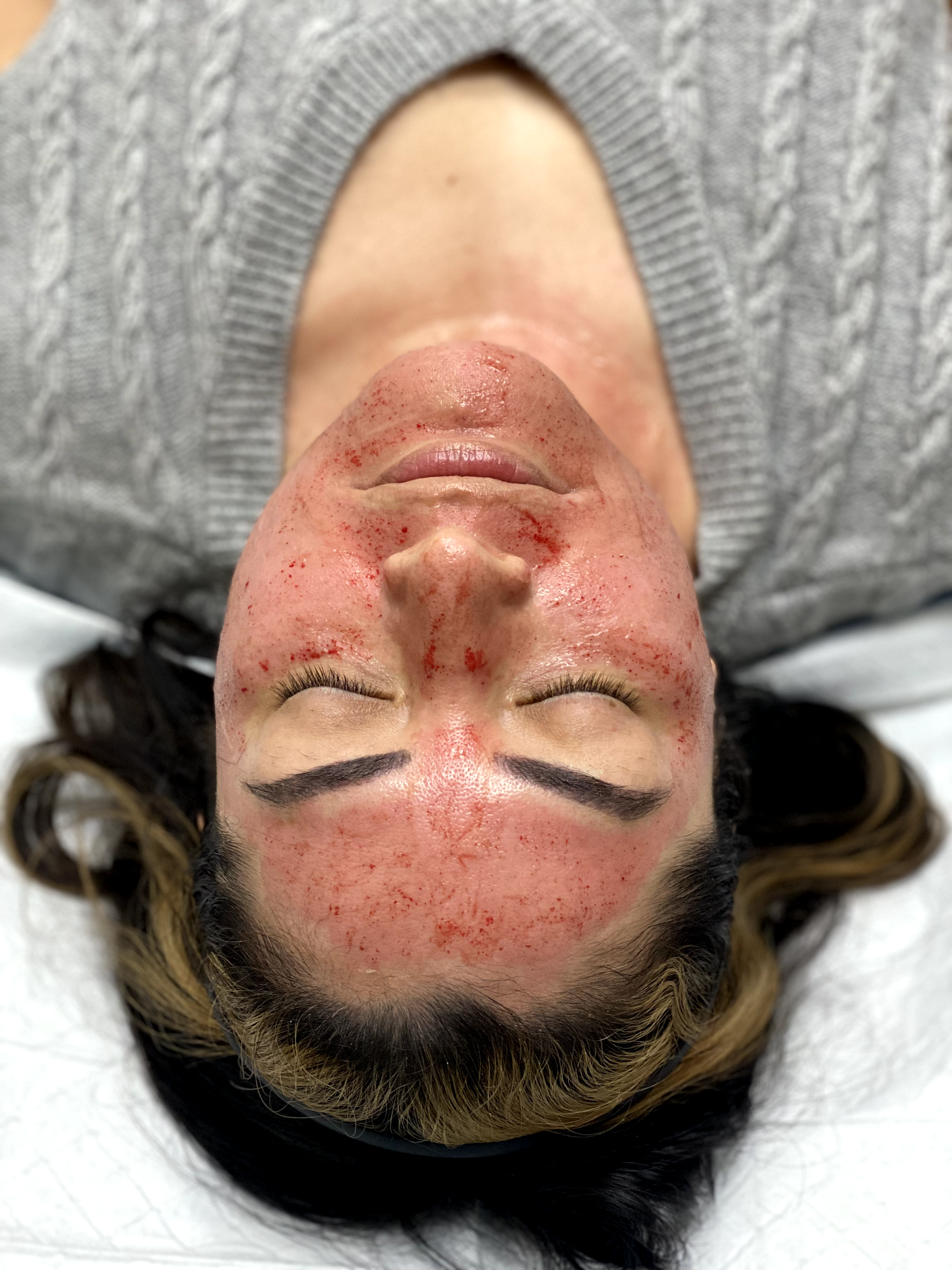 Microneedling with Prf in Houston Texas