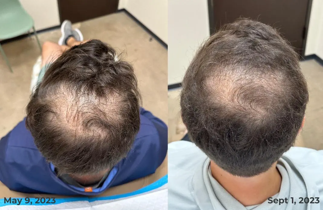 Hair Restoration in Houston Texas