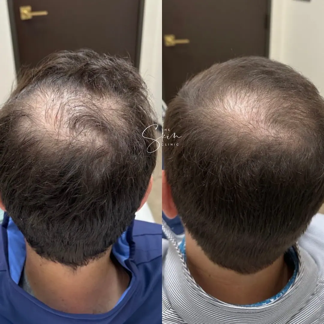 Hair Restoration in Houston Texas