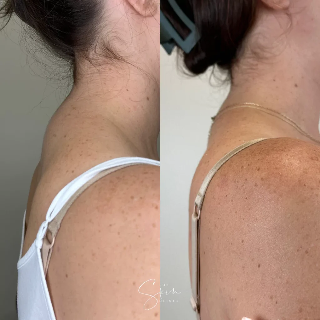 Kybella Treatment in Houston Texas