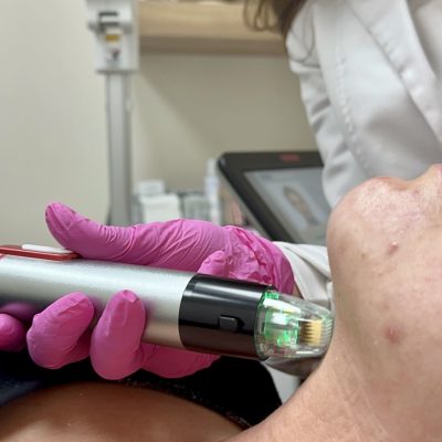RF Microneedling Treatment by The Skin Clinic in Houston Texas