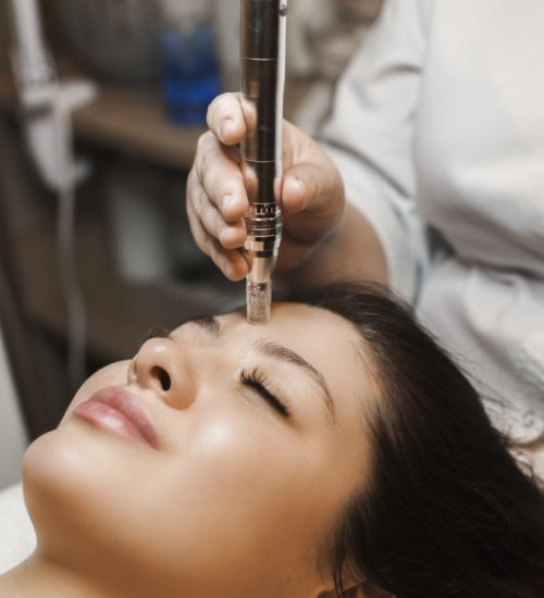 RF Microneedling Services in Houston Texas by The skin clinic