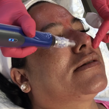 SKIN PEN MICRONEEDLING WITH PRF
