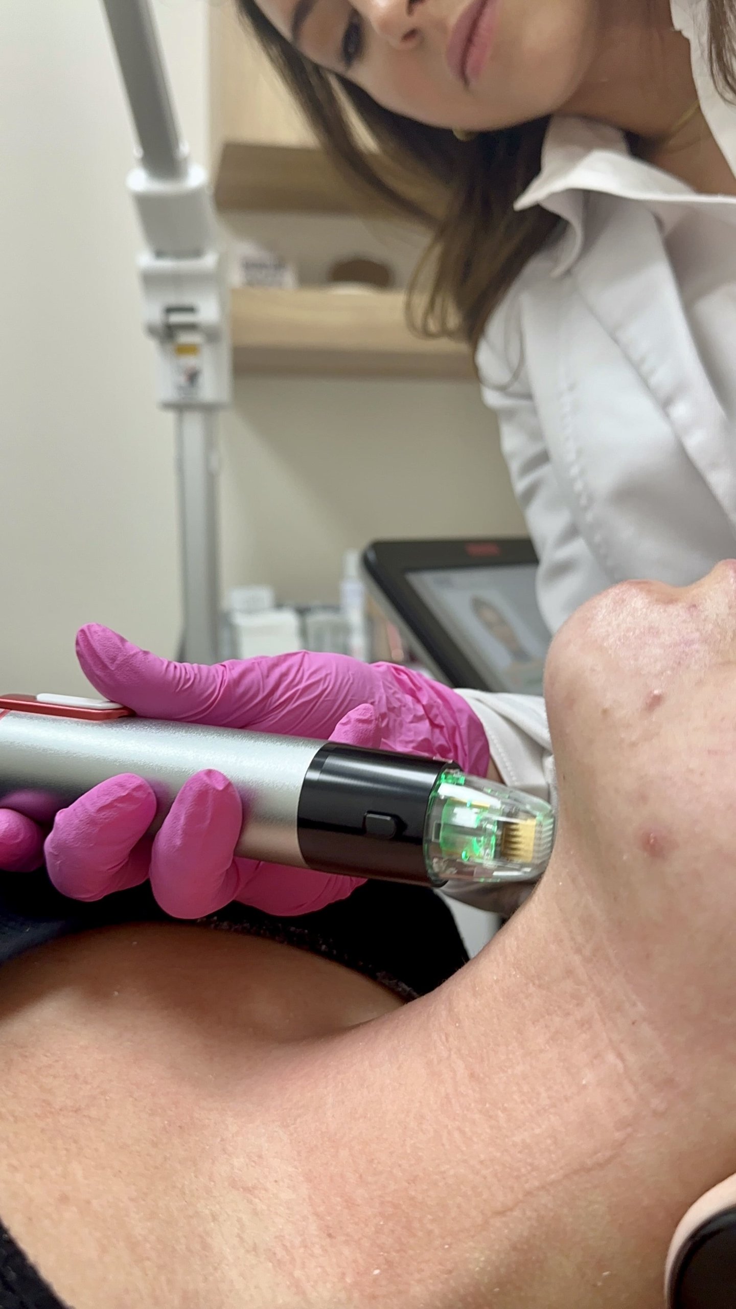 RF Microneedling Treatment by The Skin Clinic in Houston Texas