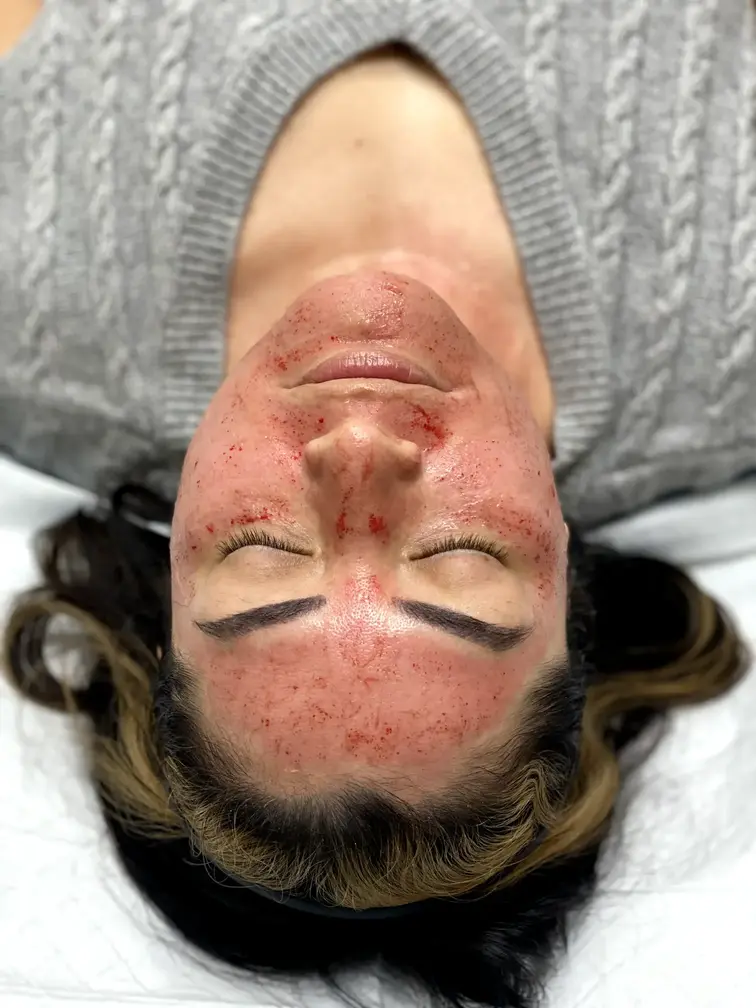 microneedling