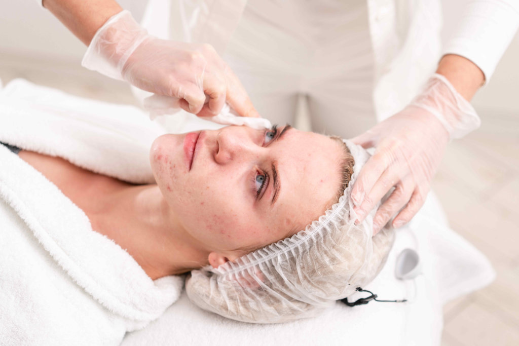 What Is The Most Efficient Acne Scar Treatment?