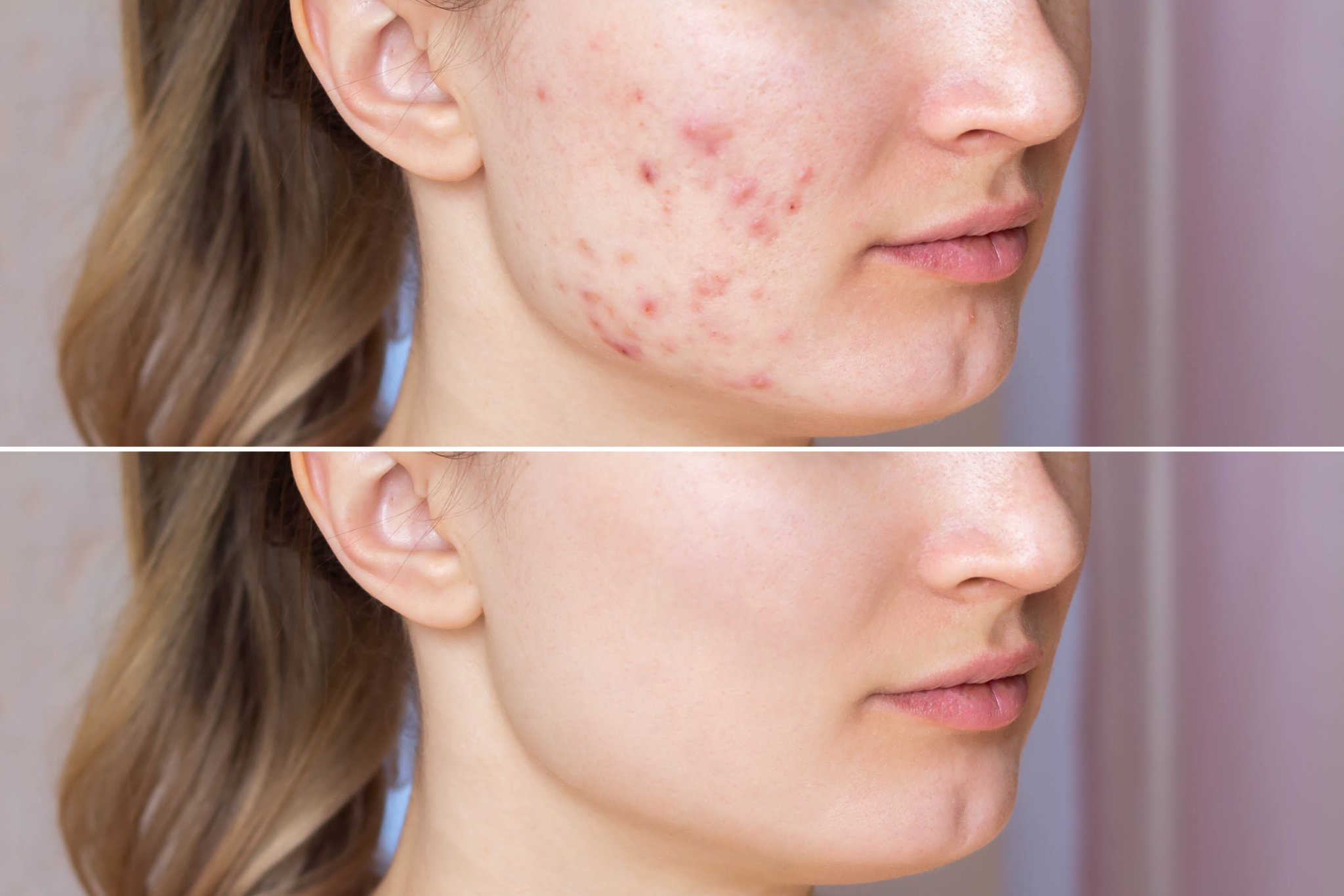 How To Get Rid Of Acne Scars Treatments And Home Remedies