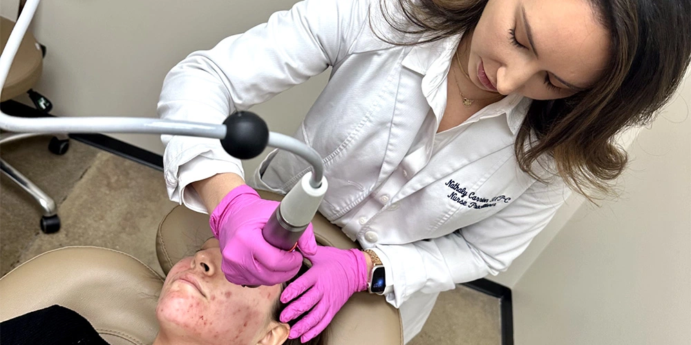 Acne scars treatment by The Skin Clinic in Houston Texas