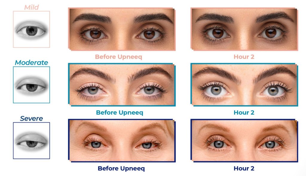 Upneeq Before and After Treatment Images