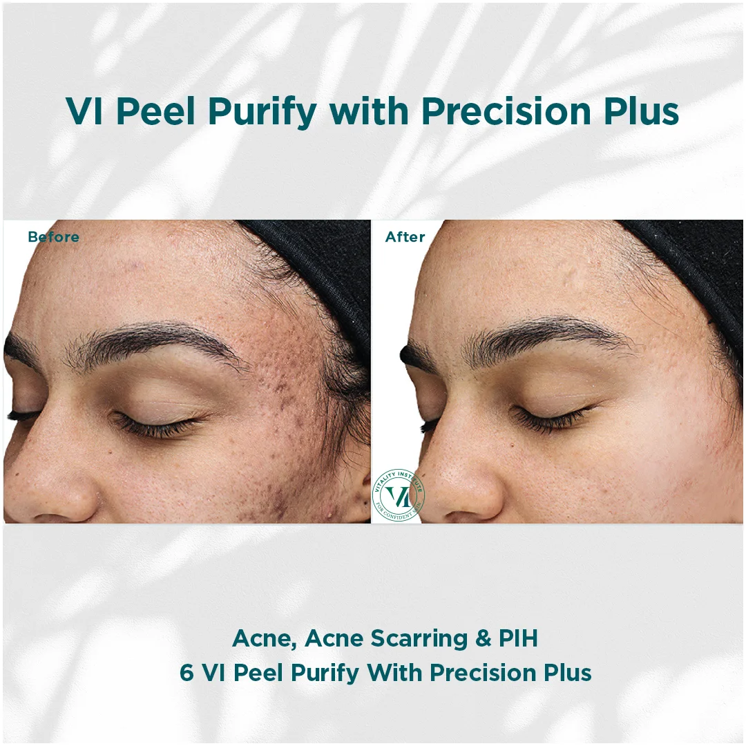 Acne Scarring in Houston Texas