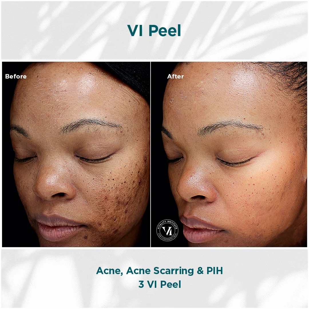 Acne Scarring in Houston Texas