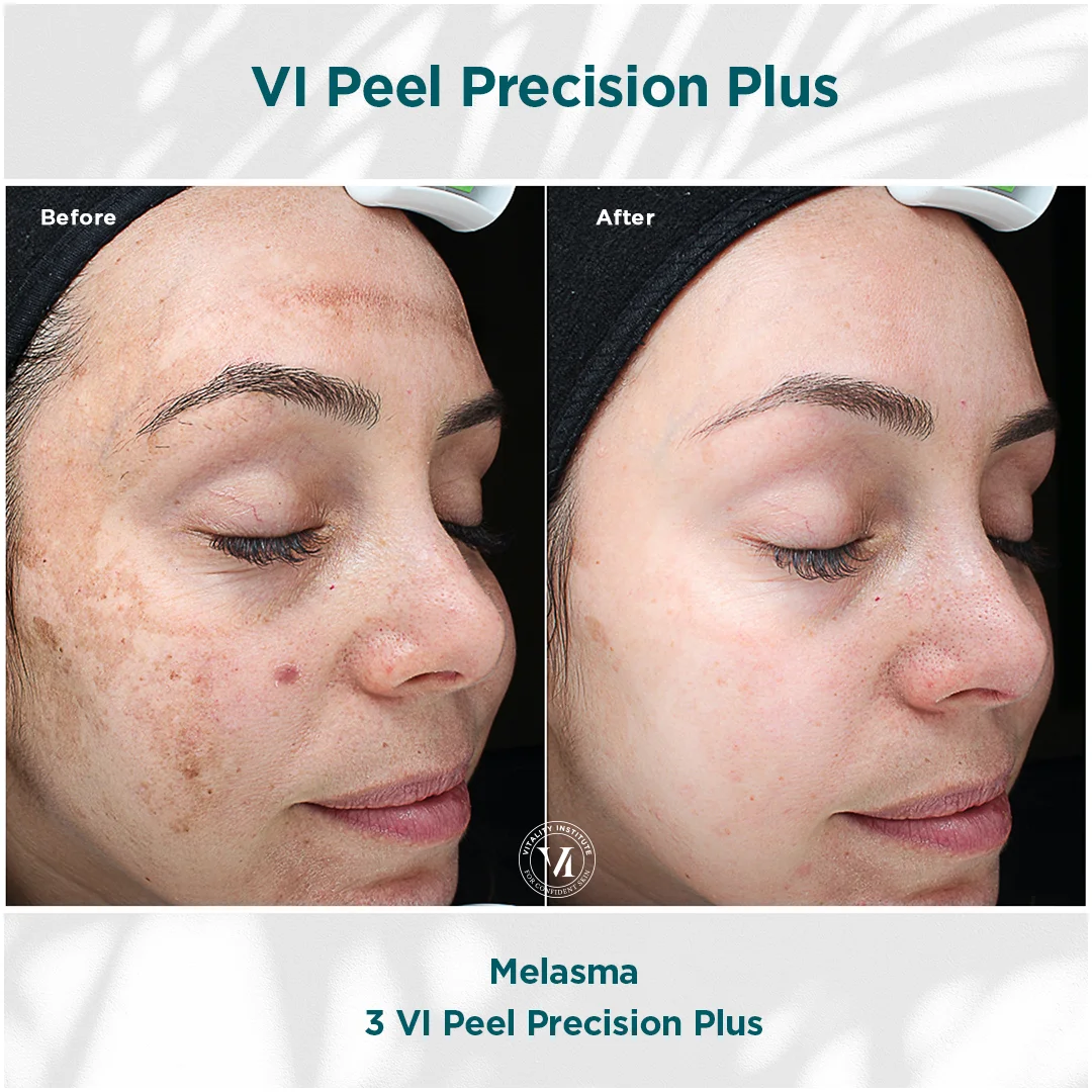 VI Peel Before and After Treatment Images