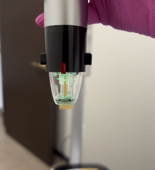 RF Microneedling treatment in Houston Texas